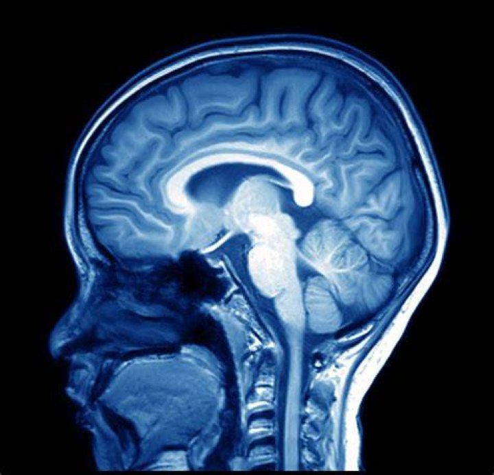 Out-of-body experience brain MRI